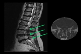 Omurga Kanal Daralmasına Kalıcı Çözüm: Minimal İnvaziv Cerrahi