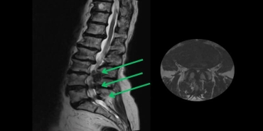 Omurga Kanal Daralmasına Kalıcı Çözüm: Minimal İnvaziv Cerrahi